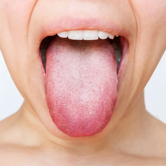 What Causes Tongue Rust?