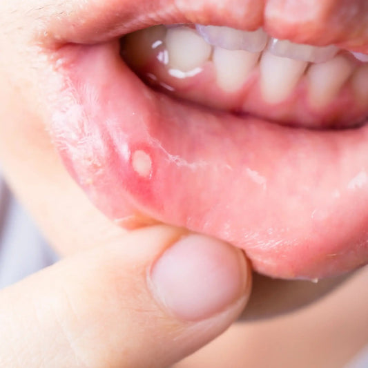 Dental Care During Mouth Sores - Docorp